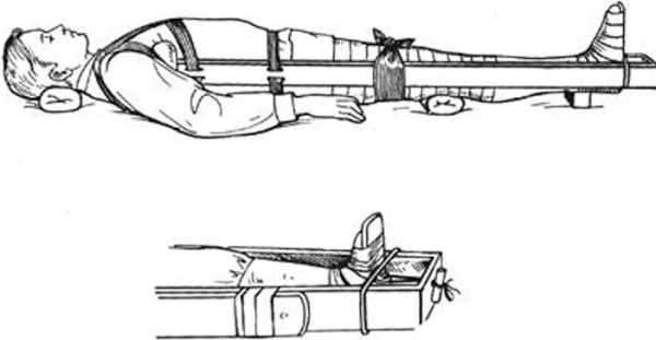 Иммобилизация при переломе бедра транспортной шиной Дитерихса