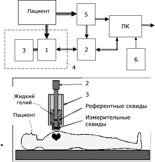 Вверху – функциональная схема магнитнокардиографа "Кардиомагскан": 1 – многоканальный магнитометр на сквидах; 2 – электронный блок; 3 – криостат с жидким гелием; 4 – криогенный модуль; ПК – персональный компьютер; 5 – электрокардиограф; 6 – программное обеспечение. Внизу – схема расположения пациента и криогенного модуля