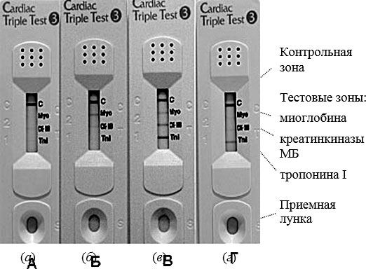 Вид иммунохроматографической тест-полоски "Cardiac Triple Test": а) в случае, если соответствующие биомаркеры не выявлены; б) если в крови пациента имеются миоглобин и небольшое количество креатиназы; в) при типичном инфаркте миокарда; г) спустя 4-5 дней после инфаркта миокарда