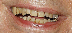 Фото для улучшения цвета зубов